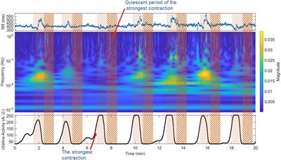 Uterine activity modifies the response of the fetal autonomic nervous system at preterm active labor